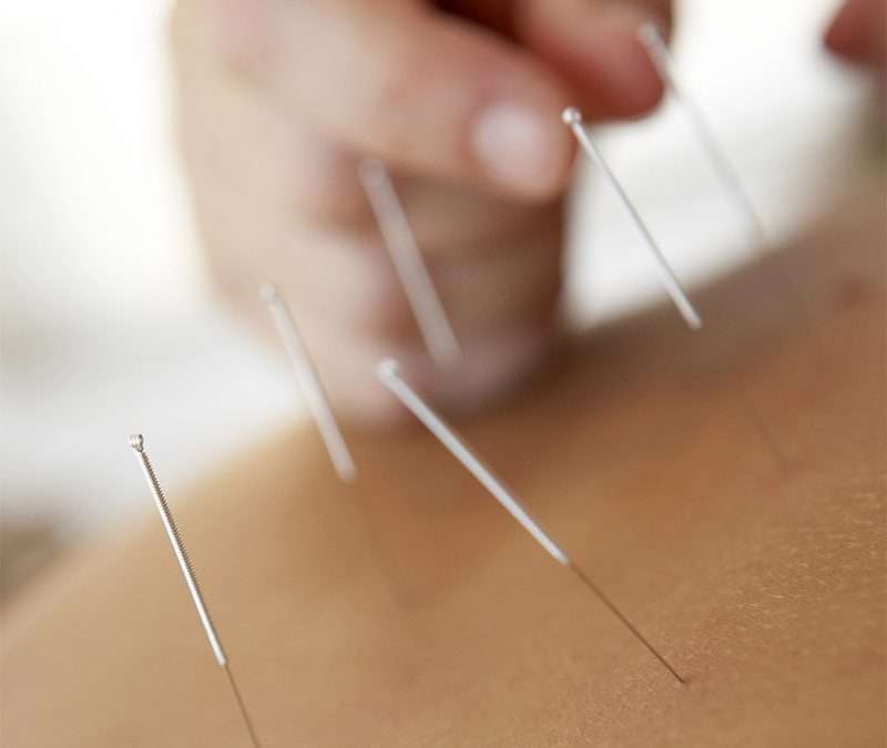 Acupuncture in North Vancouver
