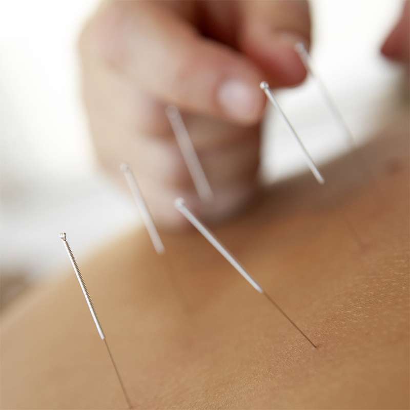 Acupuncture North Vancouver